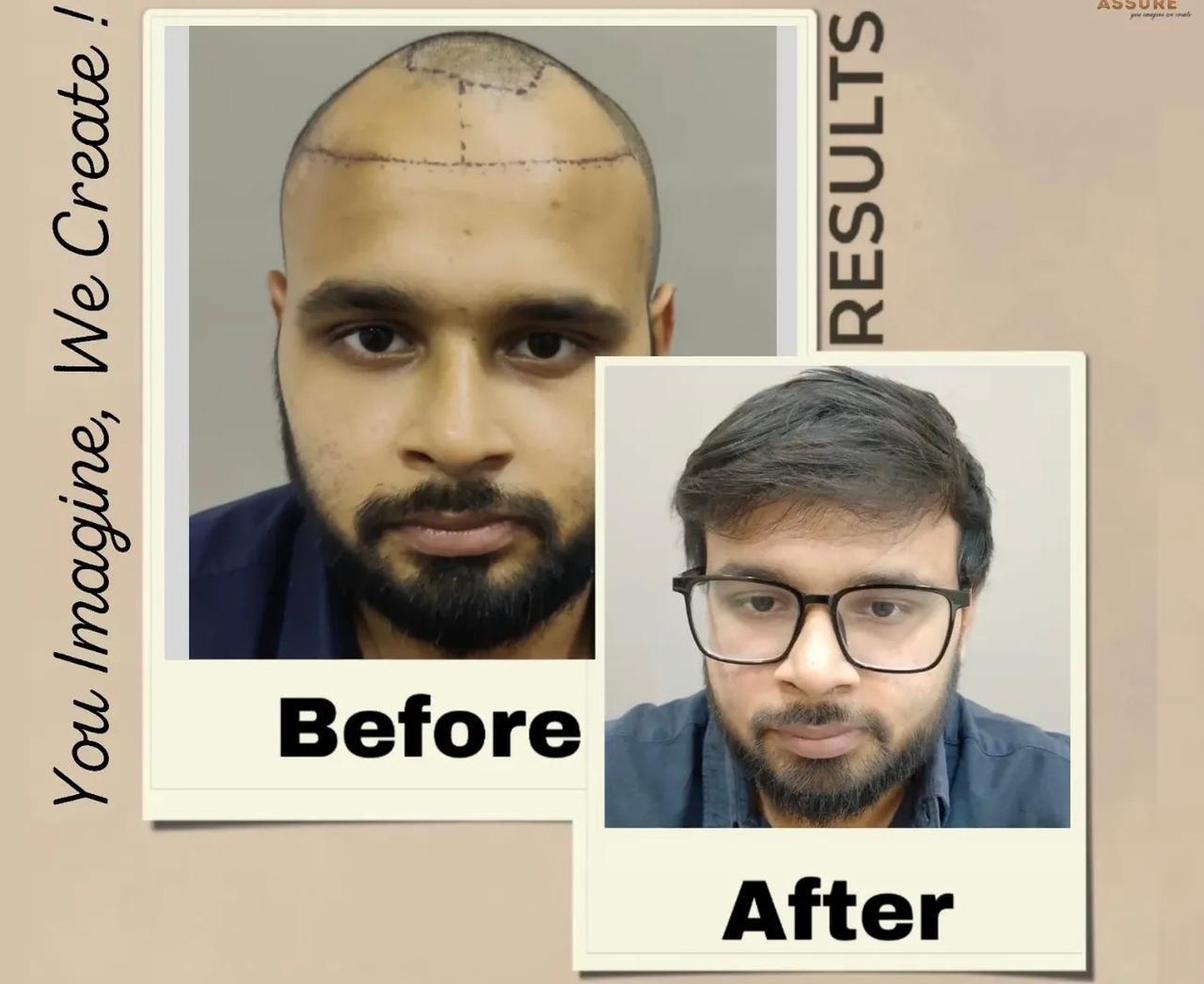 Hair restoration — before and after