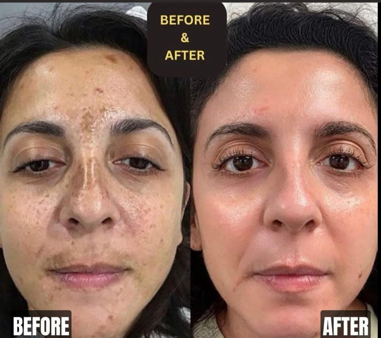Hyperpigmentation reduction — before and after