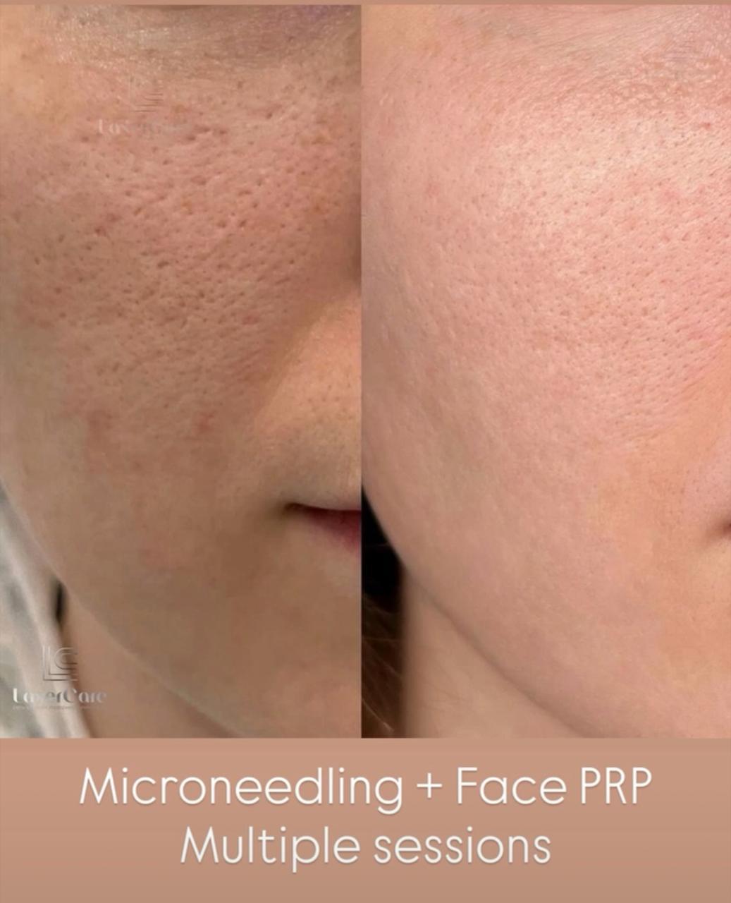 Microneedling and Face PRP — before and after