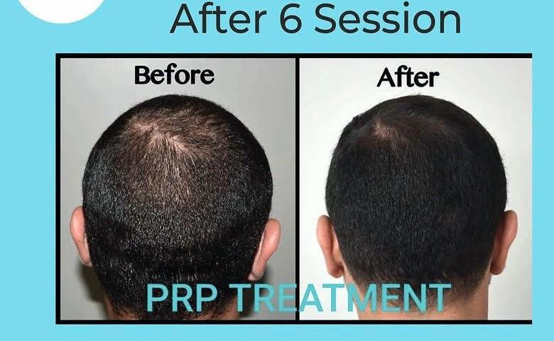PRP hair treatment — before and after 6 sessions