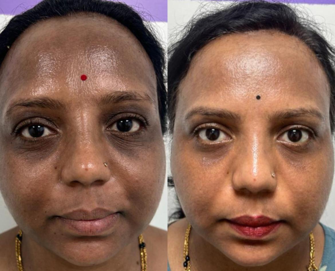 Skin tone and radiance — before and after
