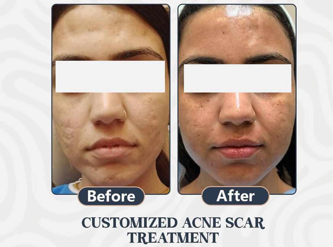 Acne scar treatment — before and after