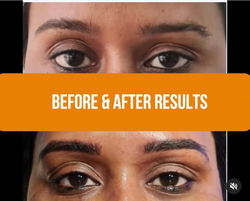 Under-eye rejuvenation — before and after