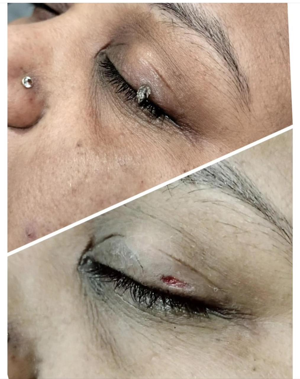 Pigmentation treatment — before and after