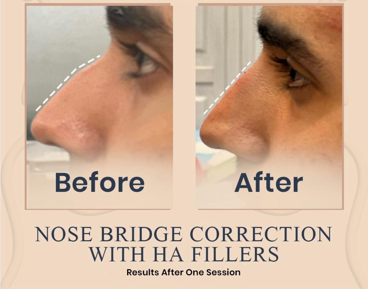 Open pore treatment — before and after