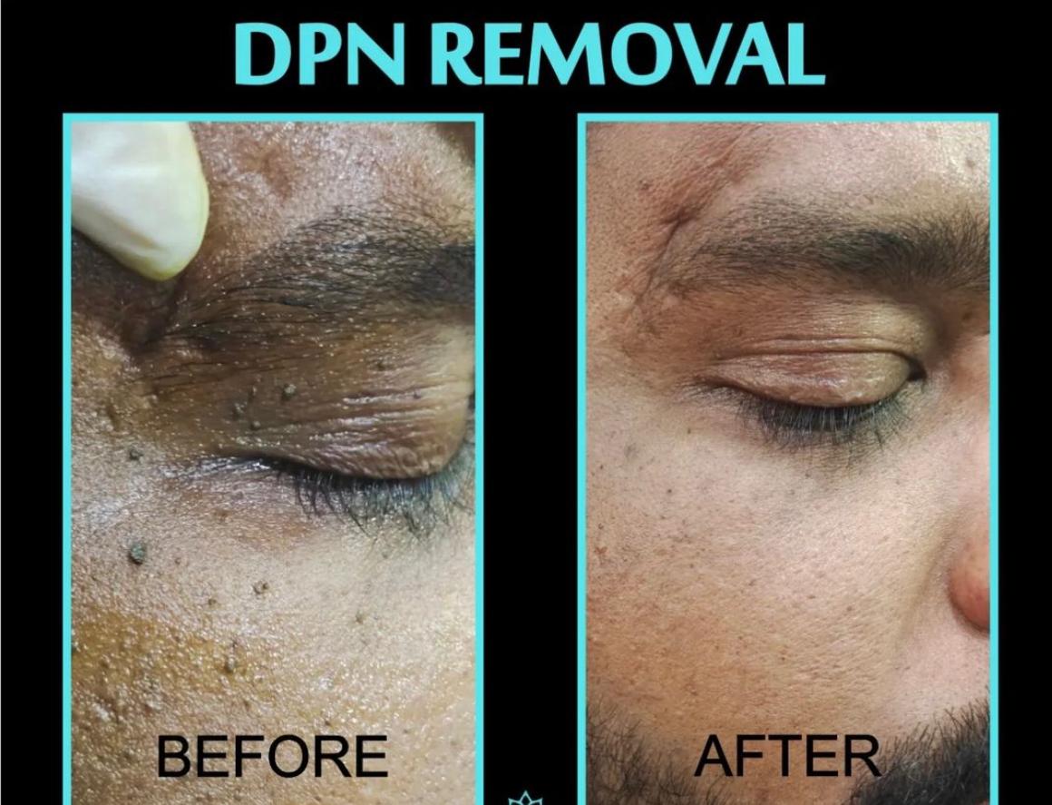Derma roller microneedling — before and after