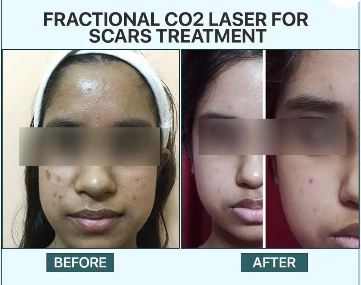 Skin tightening — before and after