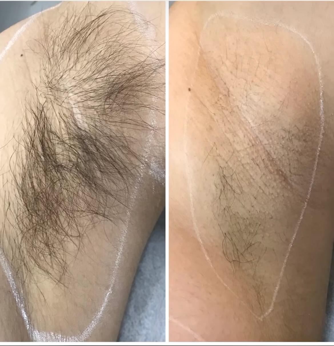 Body contouring — before and after