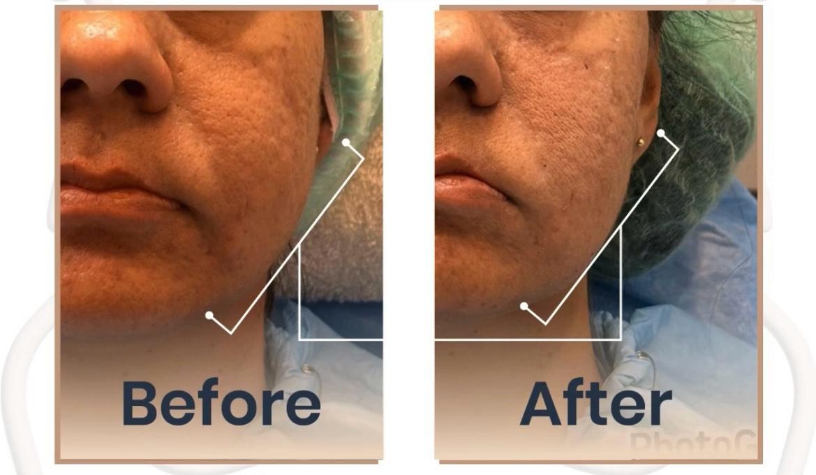 Carbon laser peel — before and after